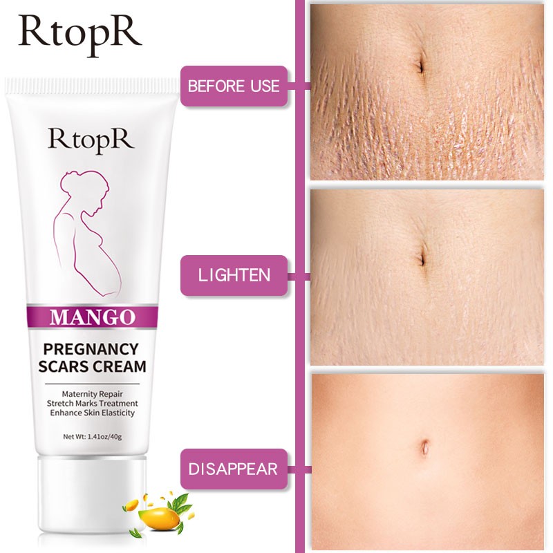 Pregnancy Mark Cream Factory - Mango Scars Acne Stretch Marks Treatment