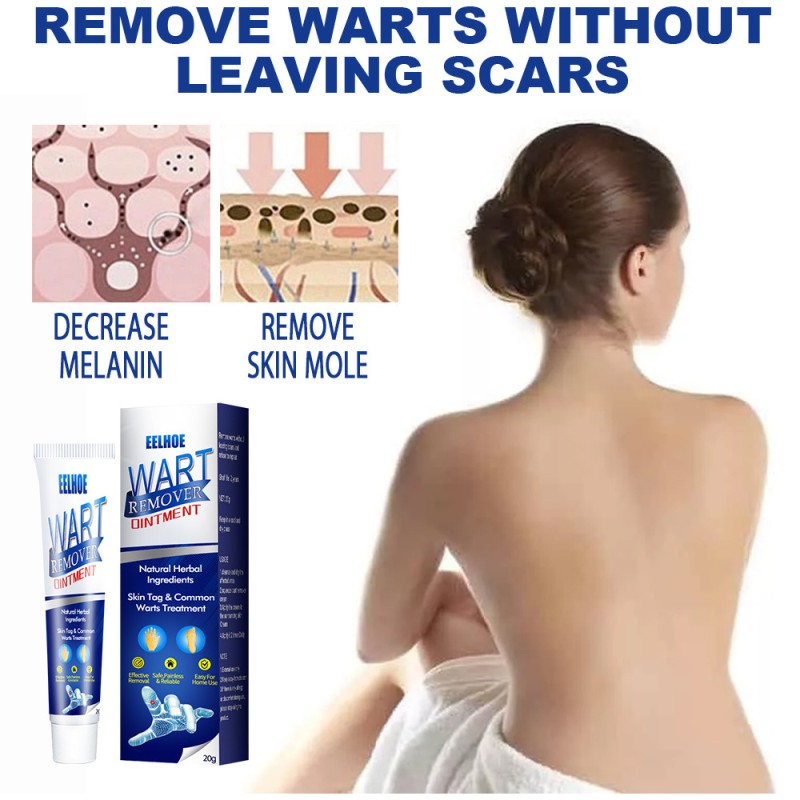 Wart Remover Supplier - Herbal Extract Corn Plaster Treatment Cream