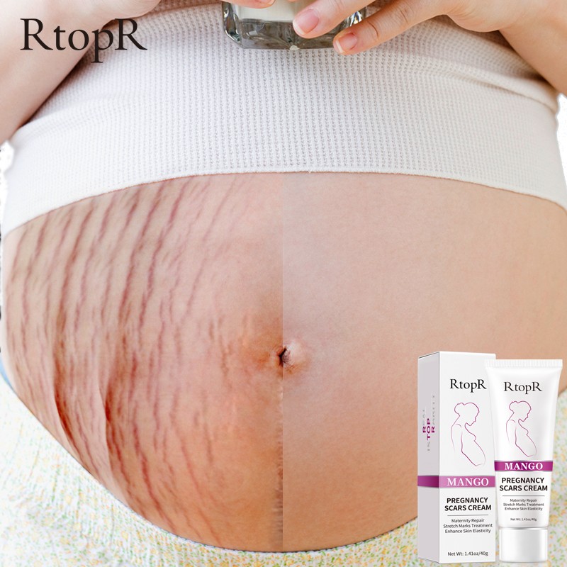 Pregnancy Mark Cream Factory - Mango Scars Acne Stretch Marks Treatment