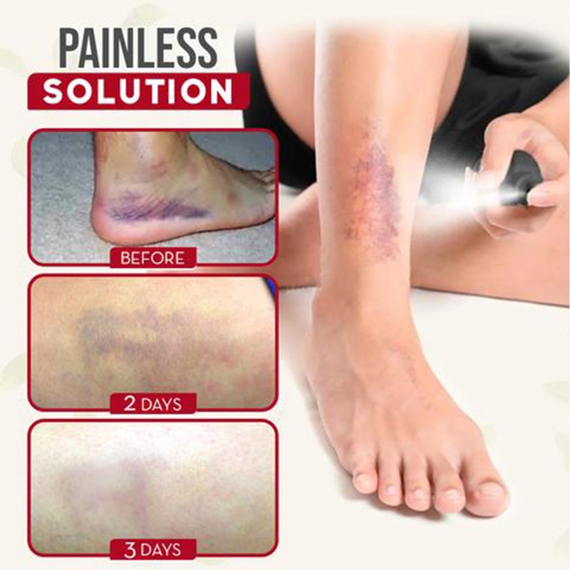 Bruise Spray Manufacturer - Muscle Strain Ankle Knee Pain Relief