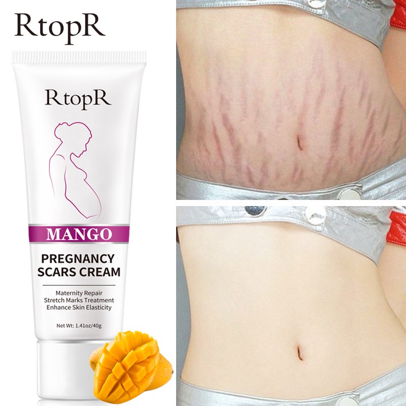 Pregnancy Mark Cream Factory - Mango Scars Acne Stretch Marks Treatment