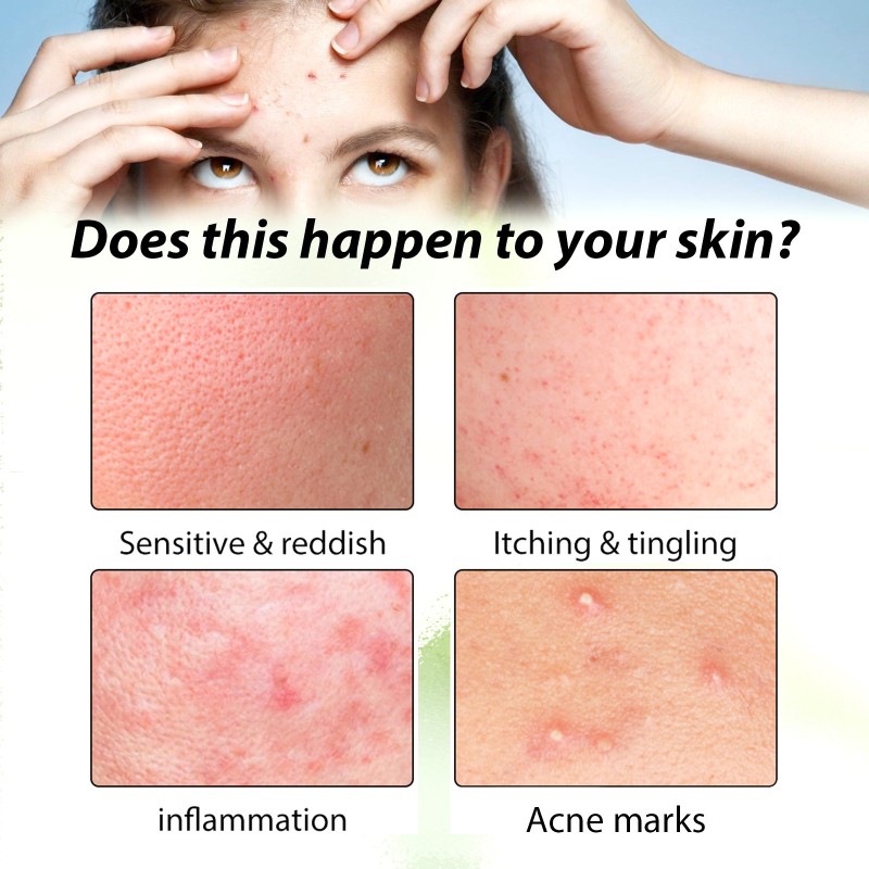 Anti Acne Serum Supplier - Tea Tree Deep Cleaning Smoothing