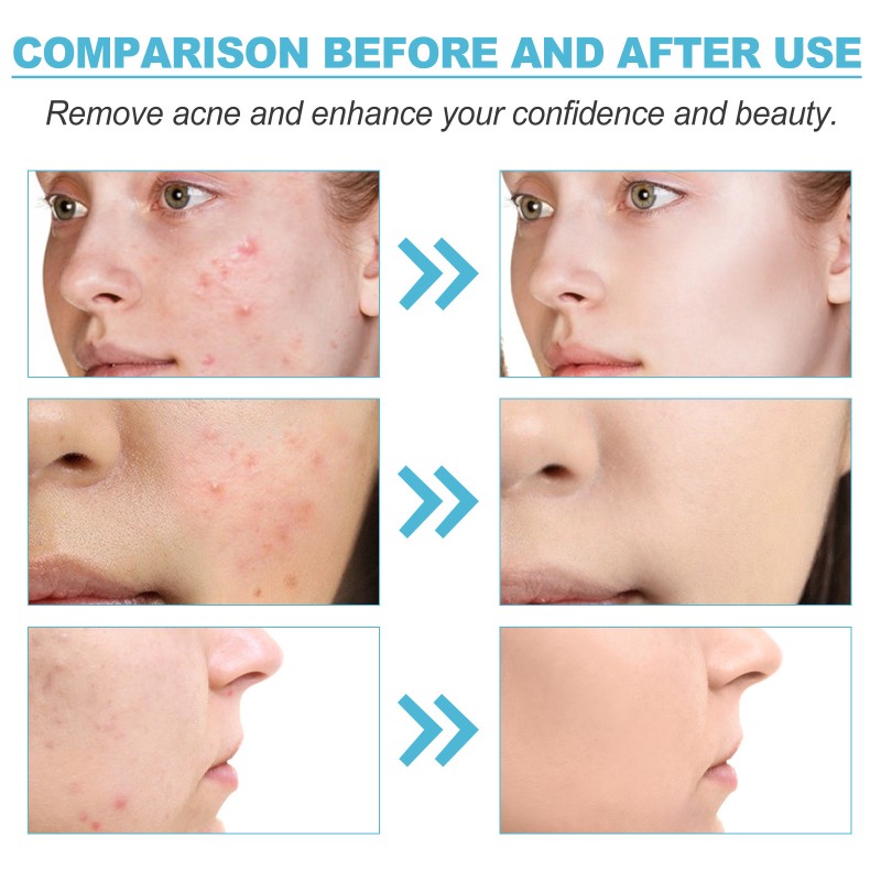 Acne Gel Supplier - 20g Dark Spot Remover Whitening