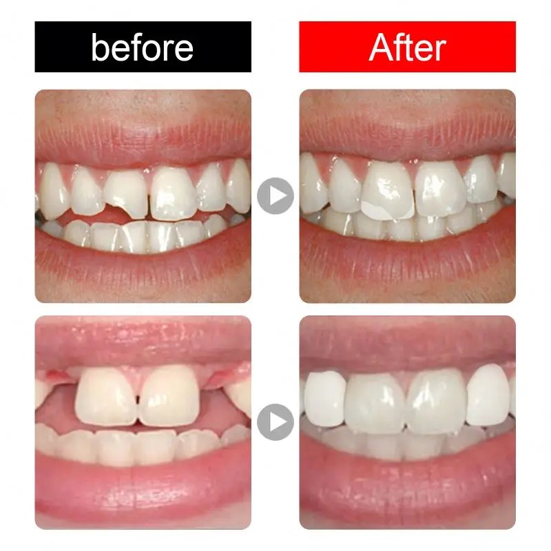 False Teeth Kit Factory - Jaysuing Moldable Temporary Solid Glue