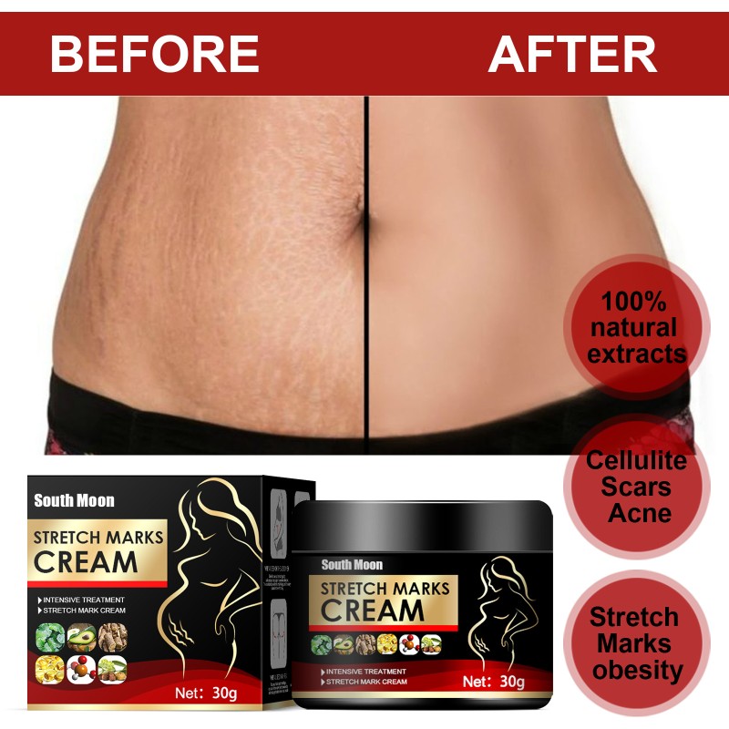 Stretch Mark Cream Factory - South Moon Postpartum Scar Removal Women