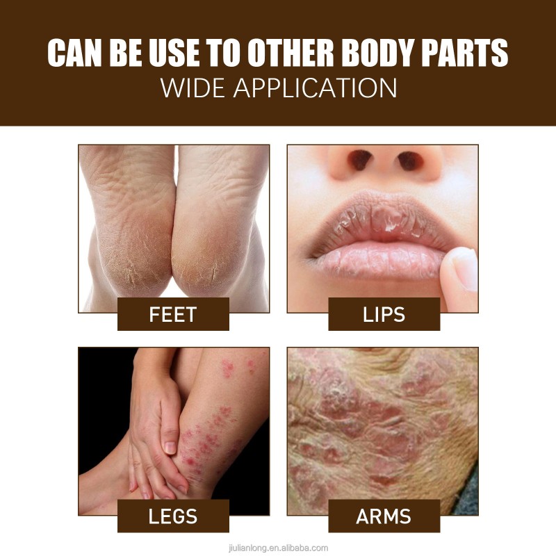 Anti-Crack Cream Factory - South Moon Heel Treatment Dry Skin Repair