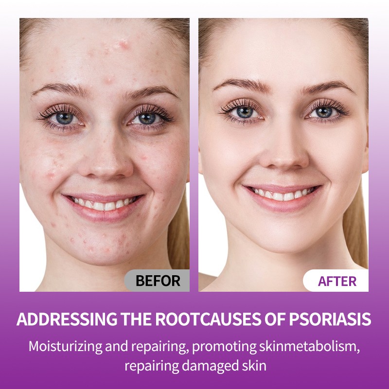 Antipruritic Ointment Manufacturer - OEM ODM External Soothing Dermatitis