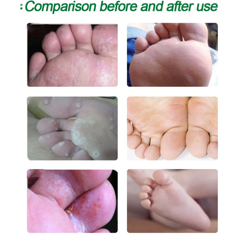 Antipruritic Cream Factory - Chinese Traditional Herbal Skin