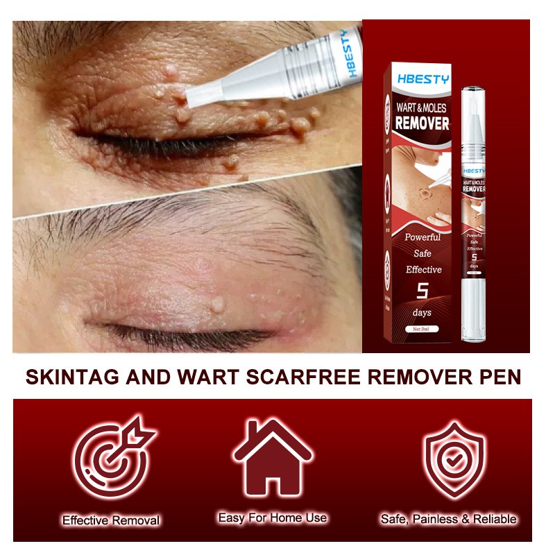 Wart Removal Pen Manufacturer - OEM Natural Herbal Safe Effective