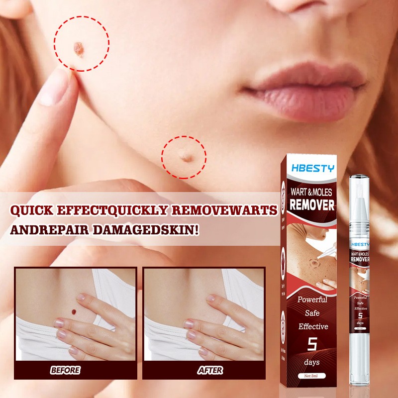 Wart Removal Pen Factory - Own Brand ODM Convenient Carrying