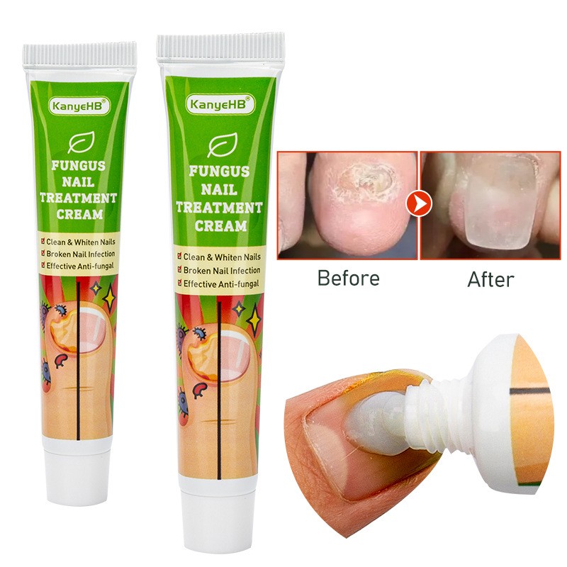 Foot Cream Supplier - Antifungal Infection Repair Gel