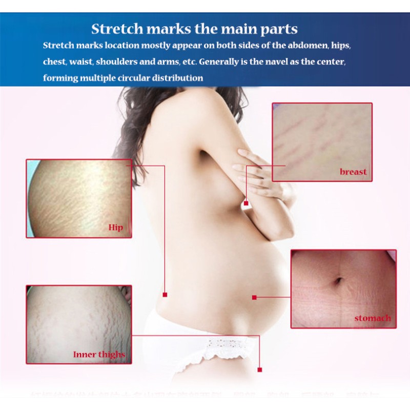 Belly Lines Cream Factory - Pregnancy Orange Peel Marks