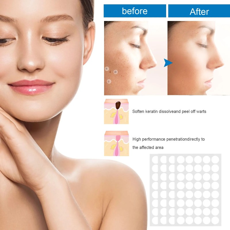 Verruca Cream Supplier - Warts Skin Tag Care Plaster