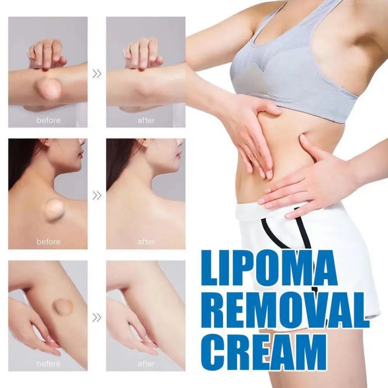 Lipoma Cream Supplier - Portable Skin Care Lotion