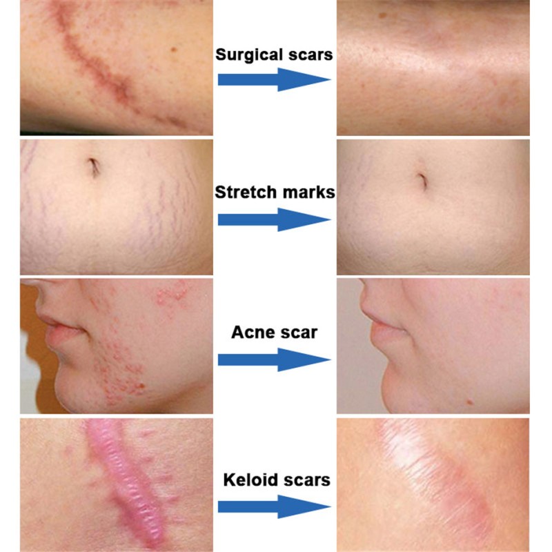Scar Removal Cream Factory - Acne Spots Burn Repair