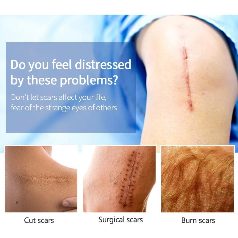 Scar Removal Cream Factory - Acne Spots Burn Repair