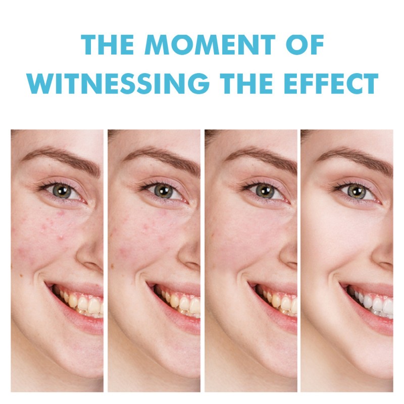 Acne Gel Manufacturer - Plant Essence Pores Shrinking