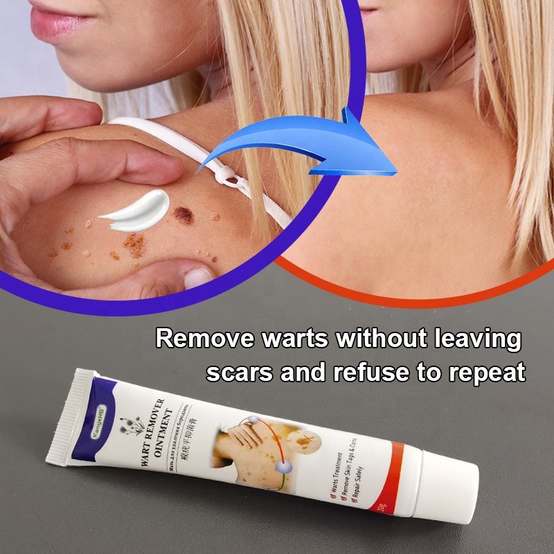 Wart Treatment Supplier - Medical Cream Neck Armpit Removal