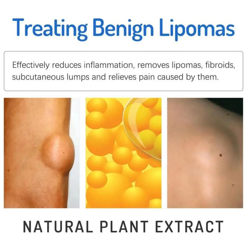 Lipoma Cream Supplier - Portable Skin Care Lotion