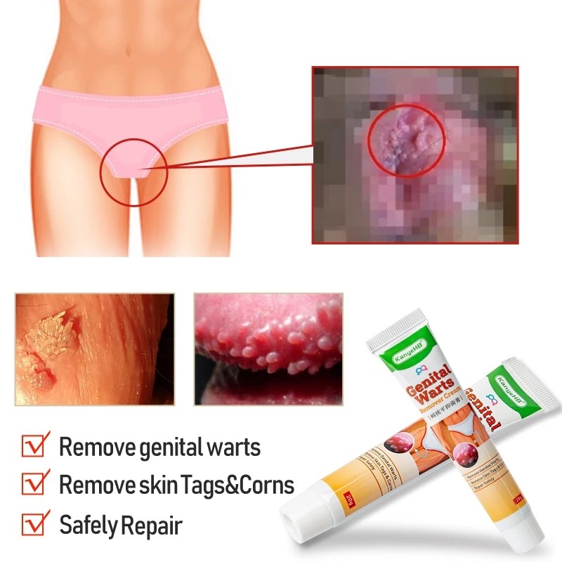 Genital Herpes Cream Manufacturer - Antibacterial Vulva Condyloma
