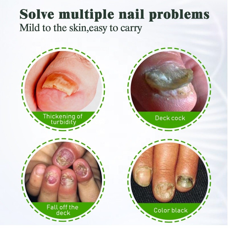 Nail Fungus Cream Factory - Strong Feet Treatment Repair