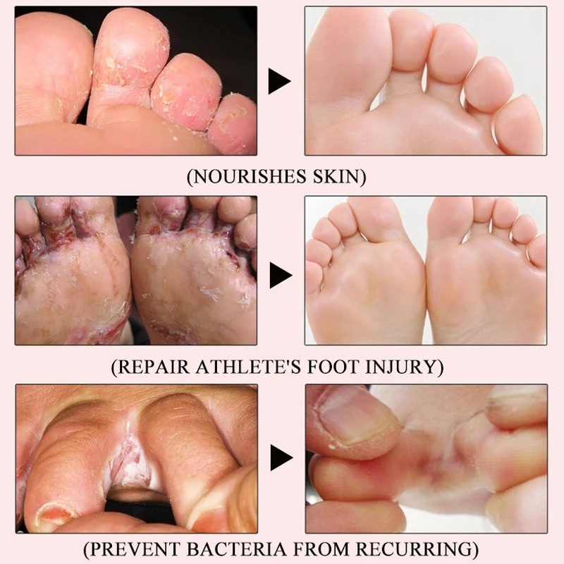 Foot Cream Supplier - Antifungal Infection Repair Gel