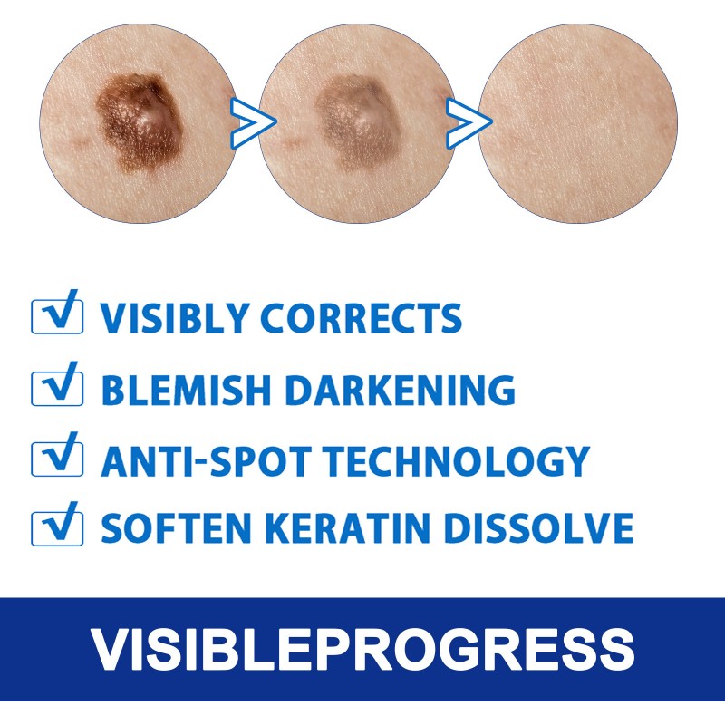 Warts Remover Supplier - Herbal Extract Skin Tag Treatment