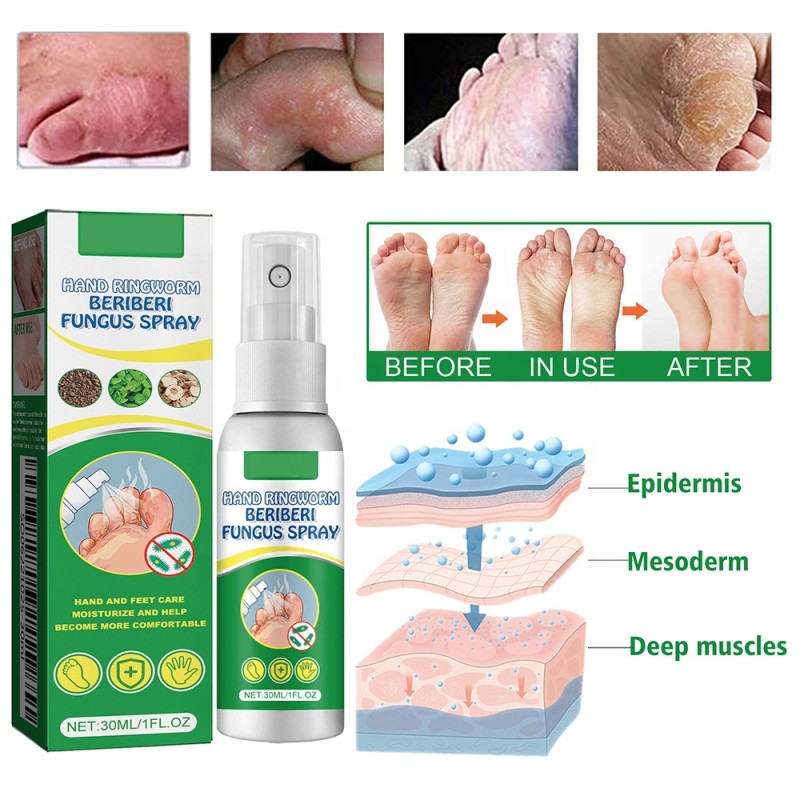 Antifungal Spray Manufacturer - Hand Foot Care Medicine Gentle Formula