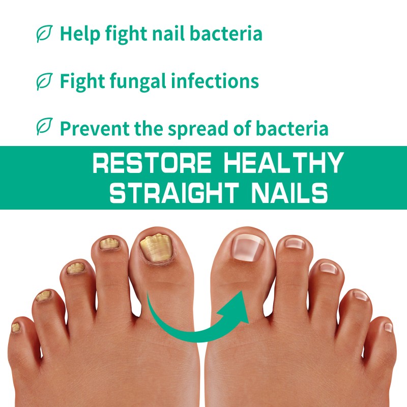 Nails Fungus Cream Manufacturer - Fungal Foot Toe Nails Gel Care