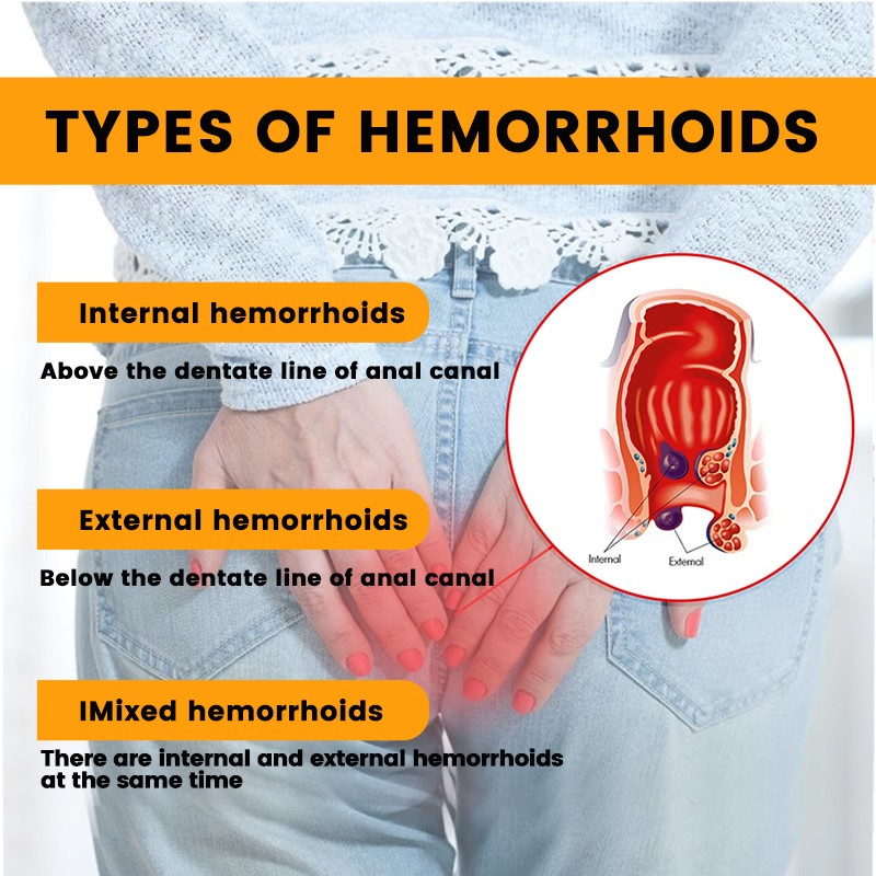 Anal Itching Gel Manufacturer - Factory Direct Sale Hemorrhoids Treatment