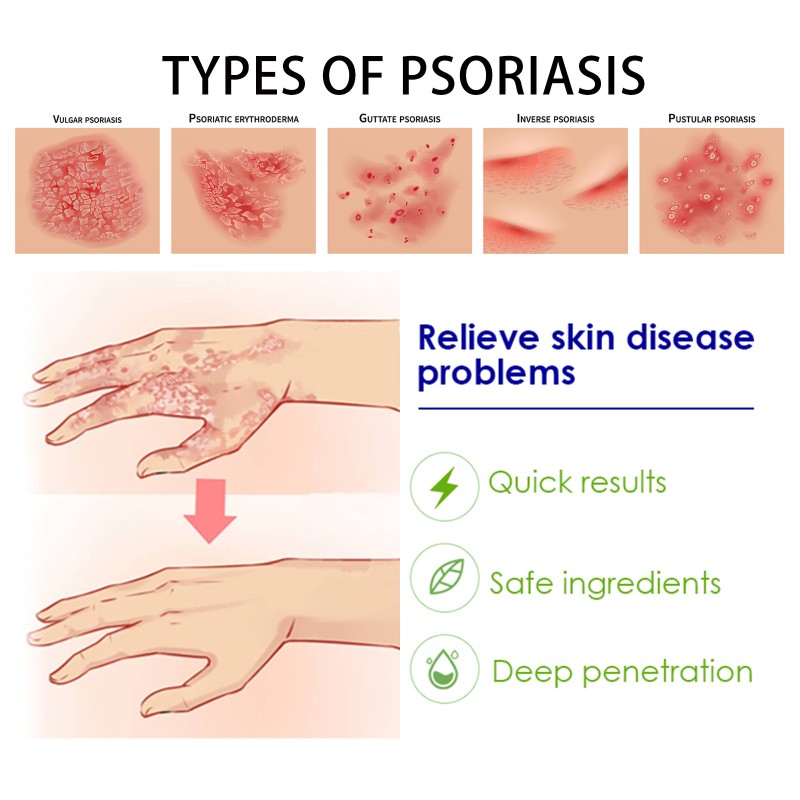 Psoriasis Ointment Supplier - 20g Acne Dermatitis Eczema