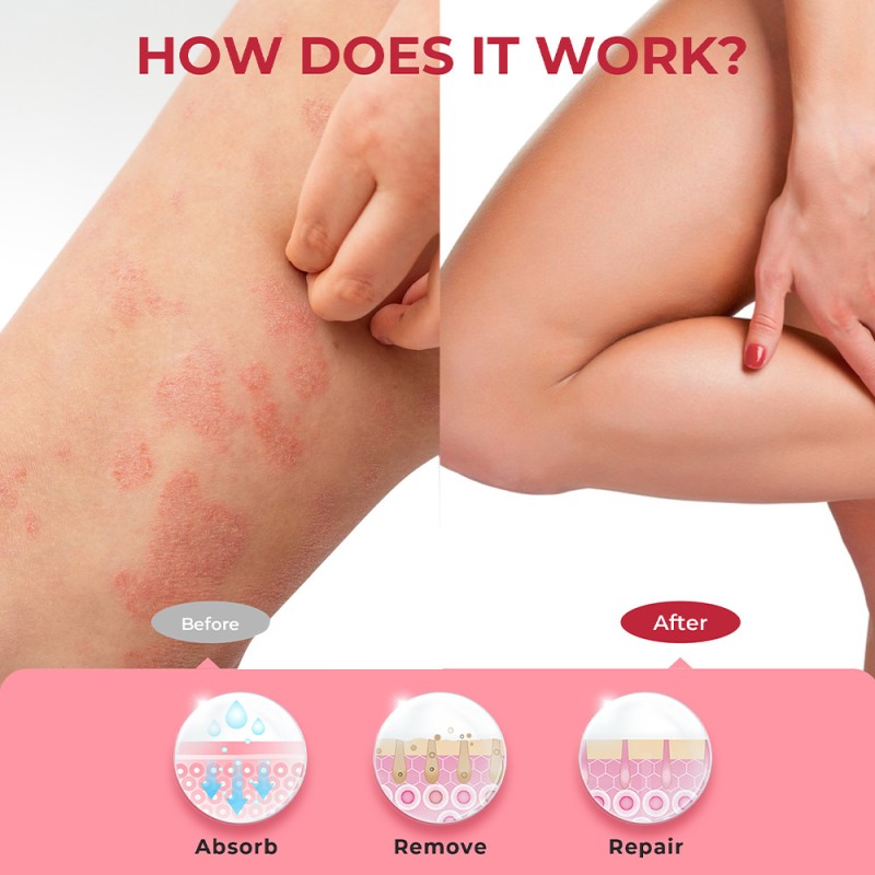 Psoriasis Cream Manufacturer - Dermatitis Eczema Herbal Ointment