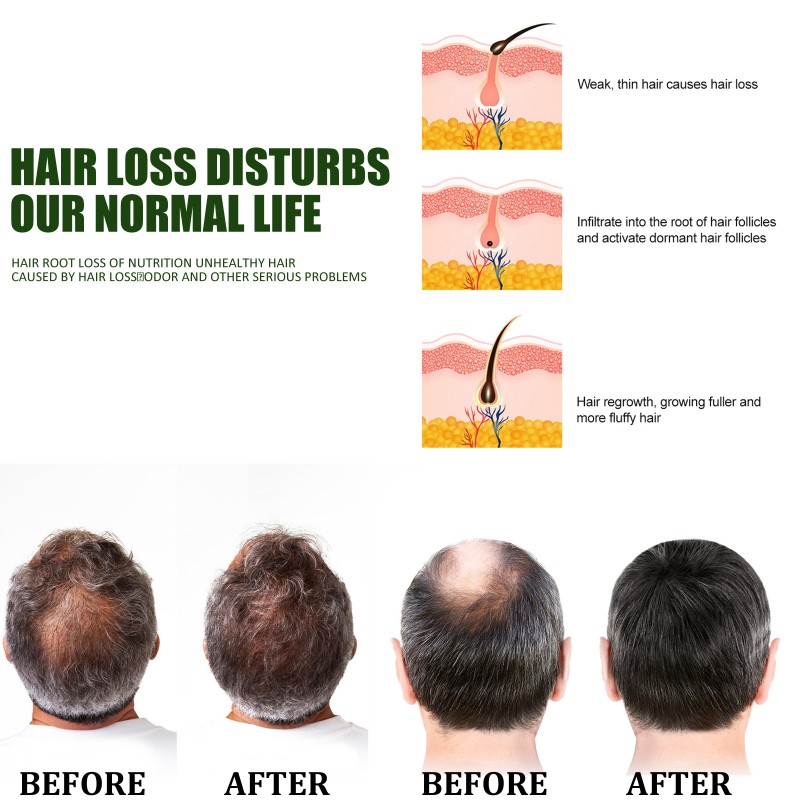 Anti Hair Loss Spray Factory - Growth Serum Treatment Care