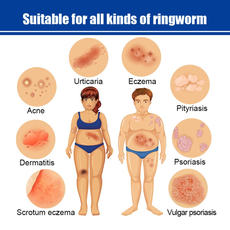 Psoriasis Ointment Supplier - 20g Acne Dermatitis Eczema