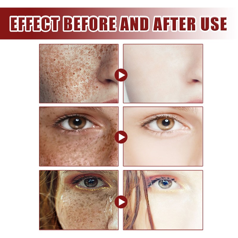 Blemish Cream Factory - Hot Sale Fade Freckles Whitening