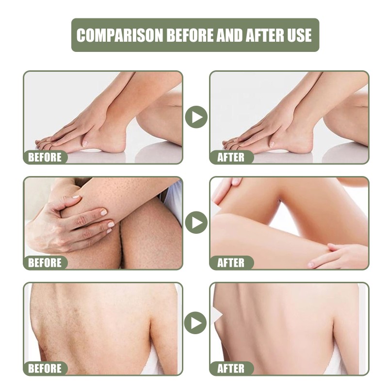 Deep Cleansing Cream Manufacturer - South Moon Rejuvenation Acne