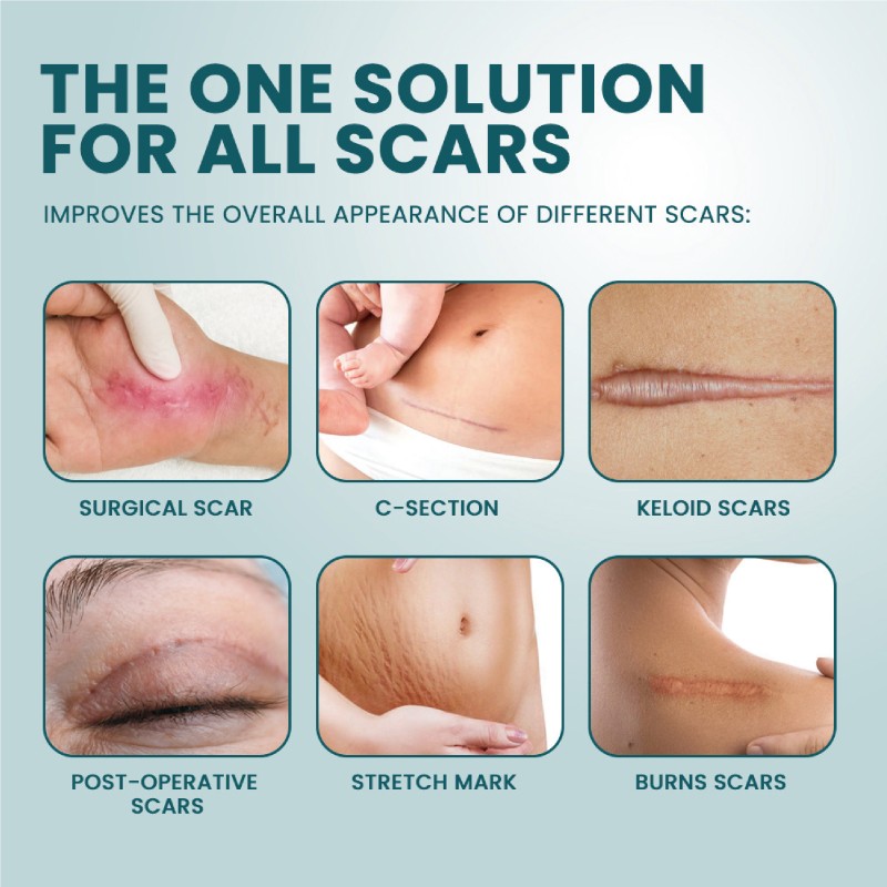 Scar Removal Patches Supplier - Medical Grade Redness Smoothing