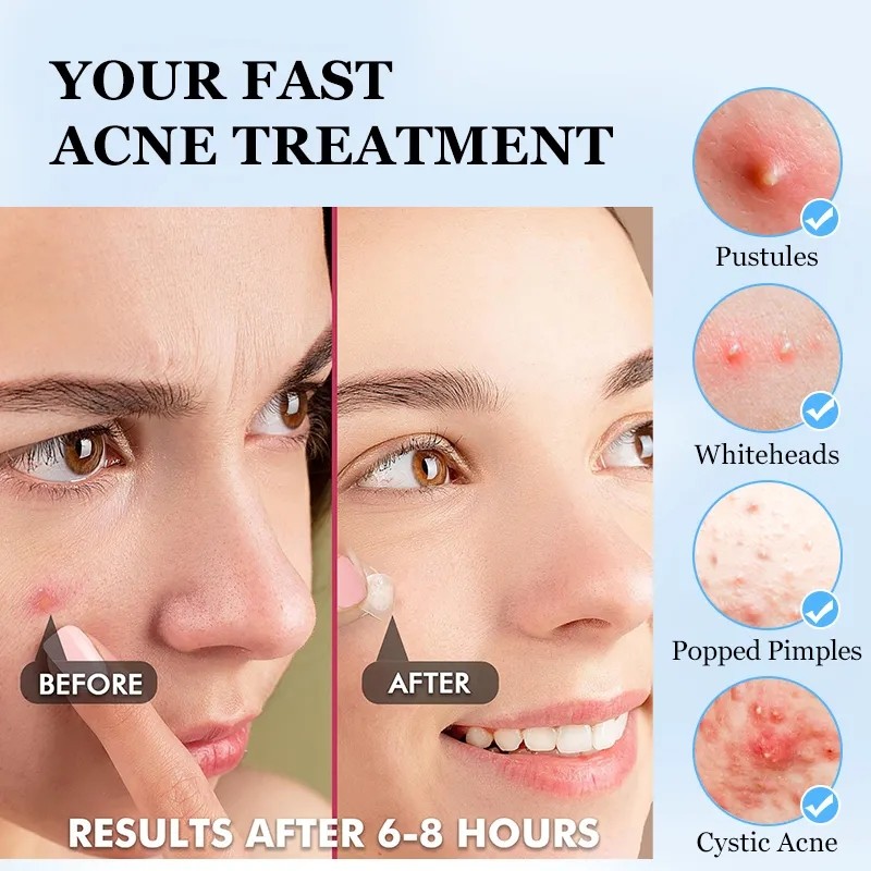 Hydrocolloid Pimple Patch Manufacturer - OEM ODM for Spot Acne Beauty Mouth Nasal