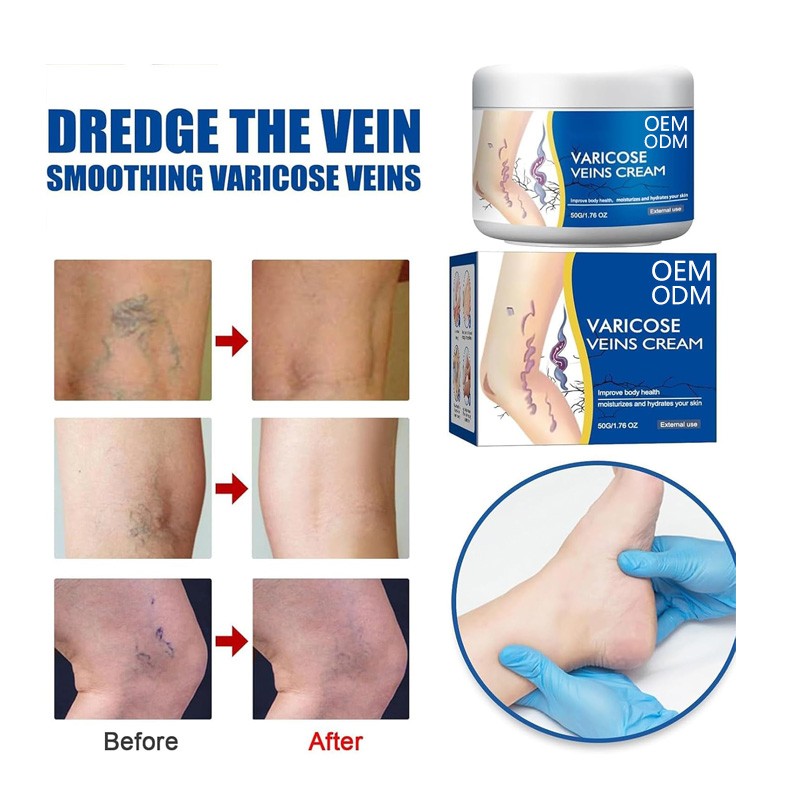 Varicose Vein Cream Factory - New Effective Herbal Ointment Vasculitis Treatment