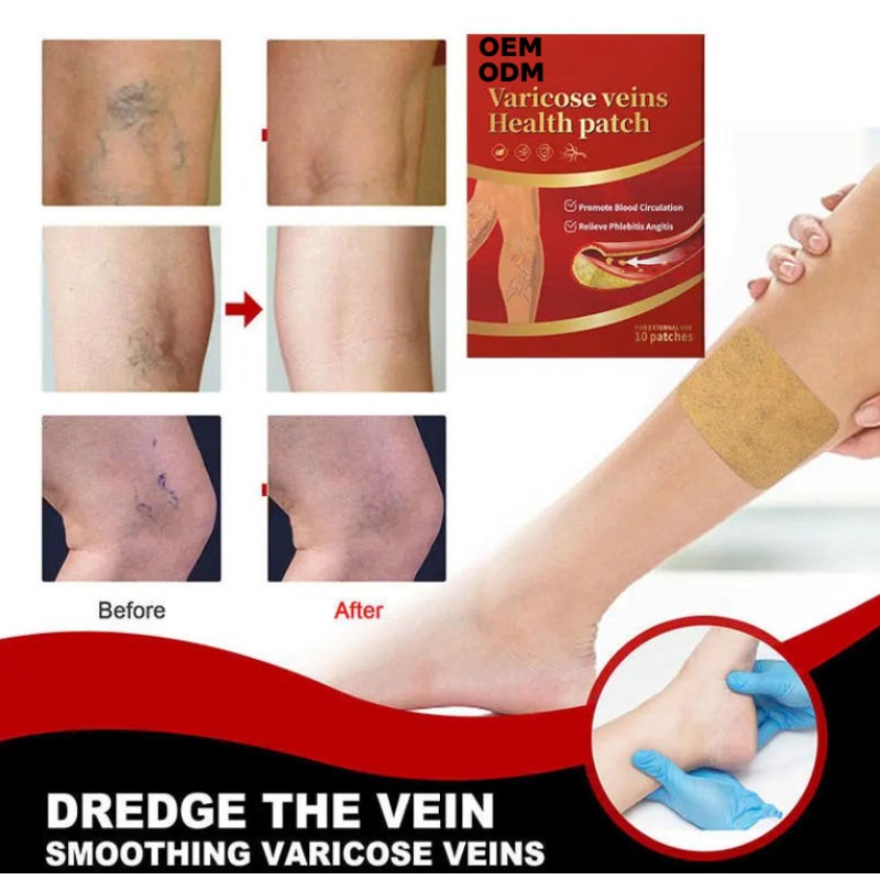 Varicose Veins Supplement Supplier - Factory Priced Herbal Improves Leg Appearance