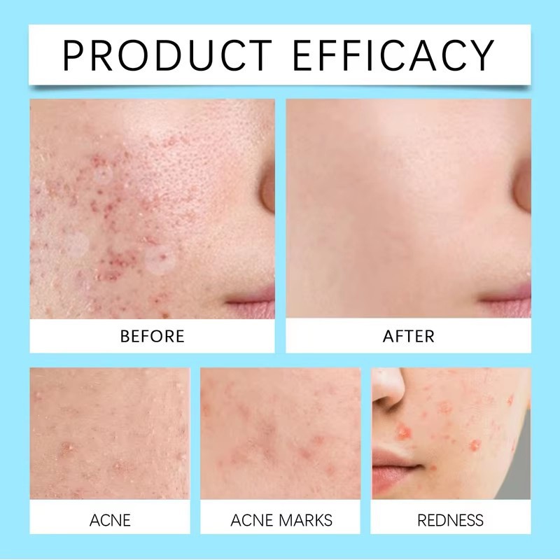 Acne Care Gel Factory - Effective Retinol Gel with Pimple Patches Improved Skin