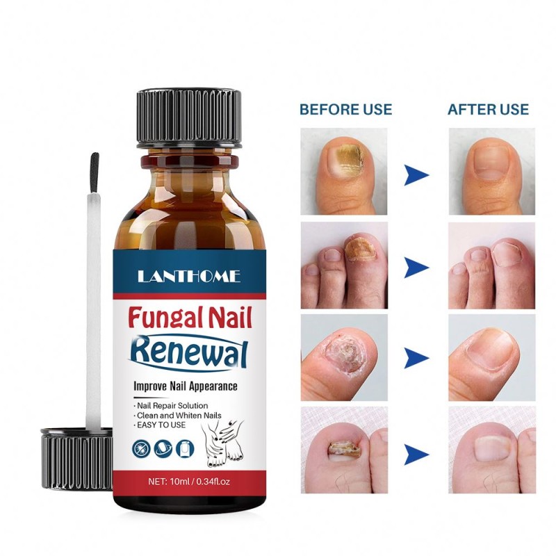 Nail Treatment Oil Factory - Herbal Anti Fungal Renew Formula