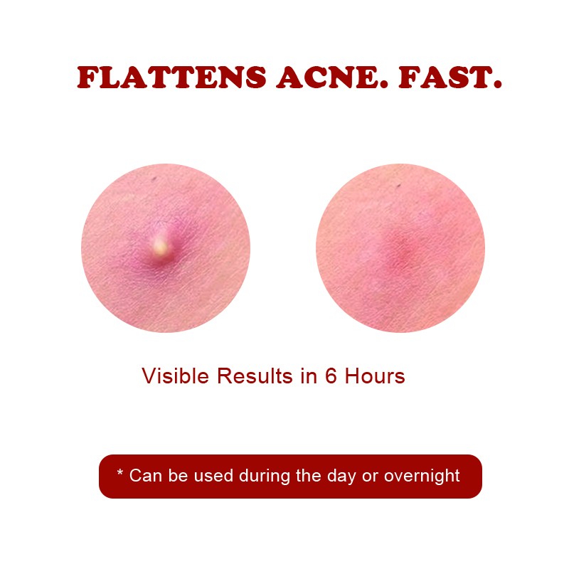 Acne Recovery Patch Manufacturer - Snow Grass Effective Bidding Farewell Acne