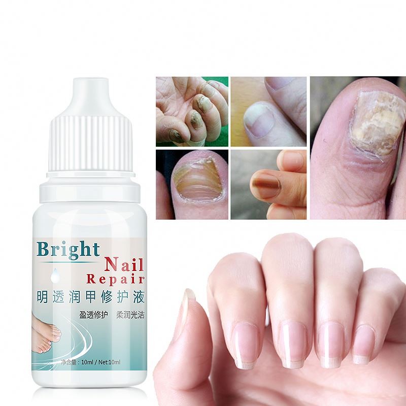 Nail Treatment Supplier - 10ml Anti Infection Nail Care Treatment