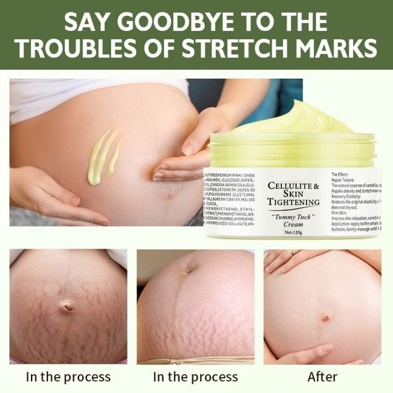 Stretch Mark Cream Manufacturer - Organic Removal Treatment Repair