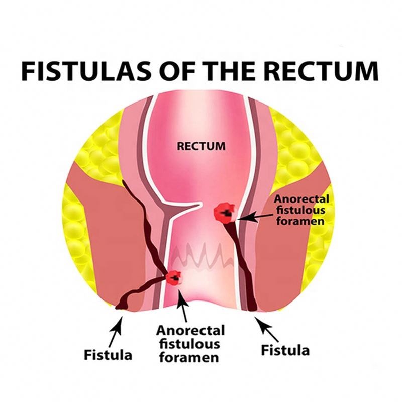 Hemorrhoids Cream Manufacturer - 25g Chinese Herbal HuaTuo Cream