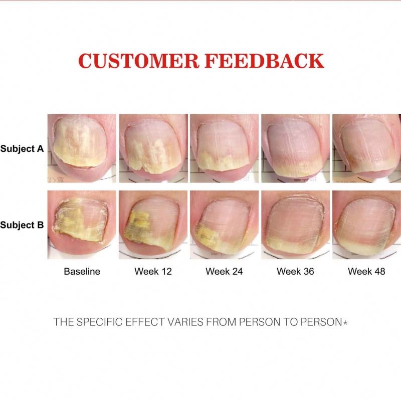 Foot Care Factory - Feet Care Anti Infection Paronychia Treatment