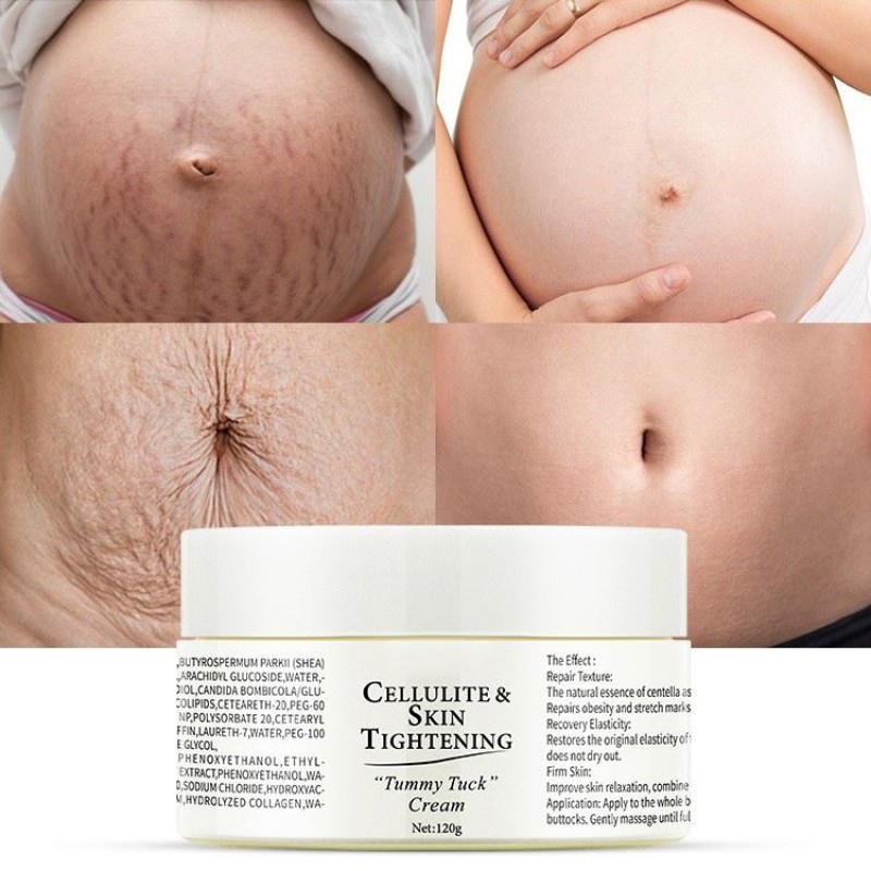 Stretch Mark Cream Manufacturer - Organic Removal Treatment Repair