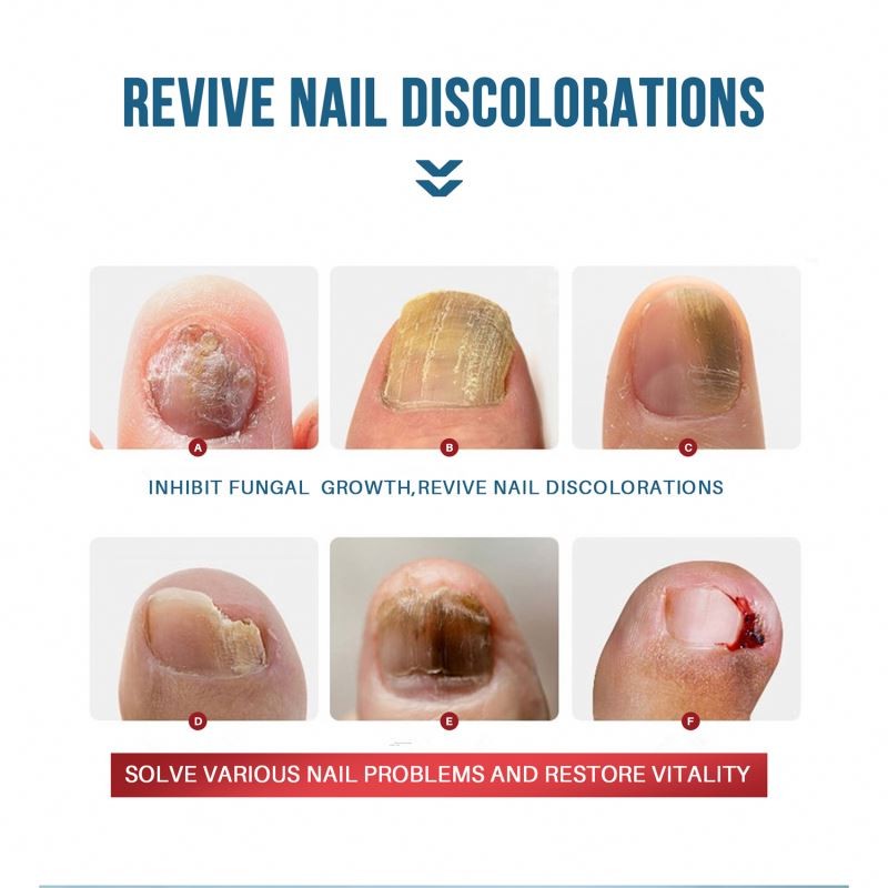 Nail Serum Factory - Natural Foot Hand Toe Fungus Removal