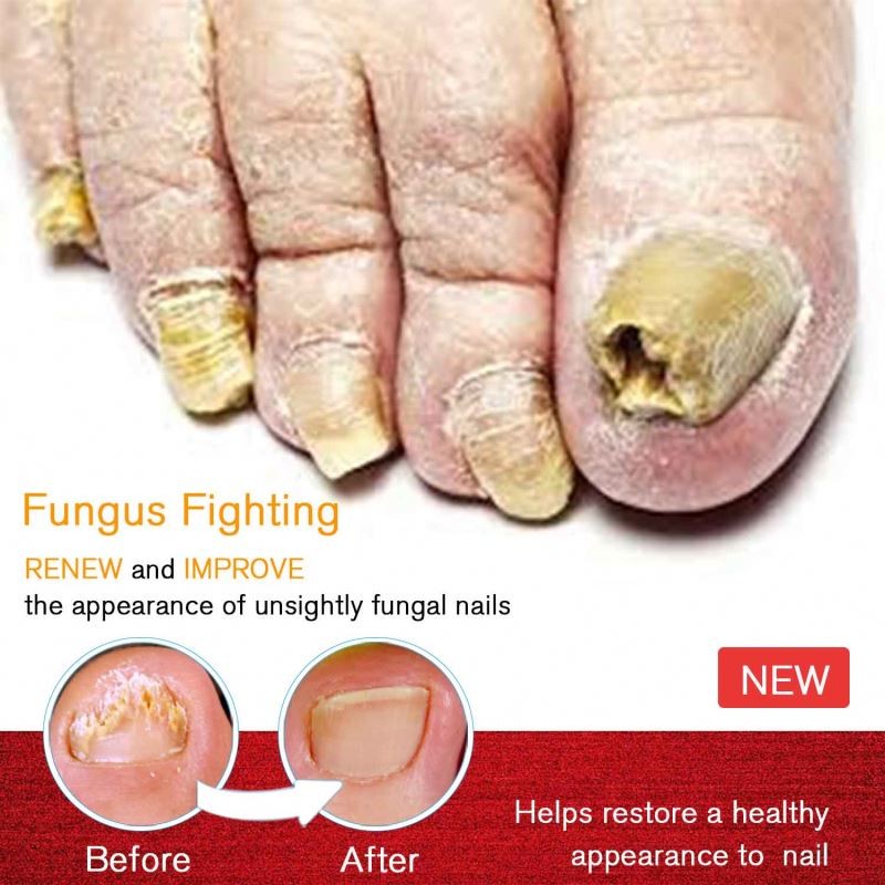 Foot Care Factory - Feet Care Anti Infection Paronychia Treatment